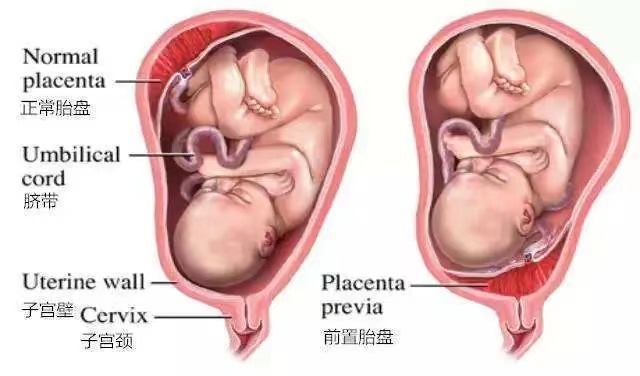  子宫保卫战之—建水县人民医院顺利完成首例胎盘位置异常引产保宫术
