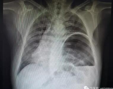  建水县人民医院成功治疗一例罕见巨大膈膨隆患者
