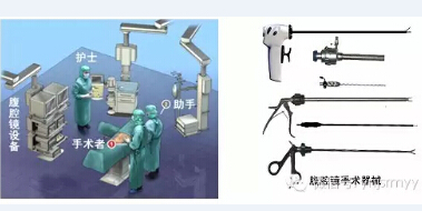  腹腔镜下疝修补术
