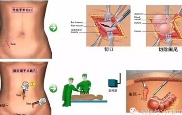  开腹阑尾炎与腹腔镜下阑尾炎的区别