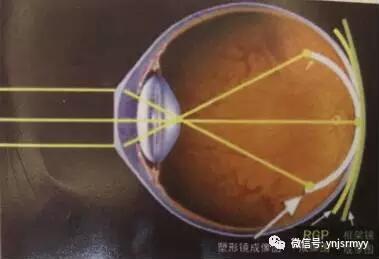  【医讯】省红会医院眼科专家将于8月11日亲临我院指导角膜塑形镜验配