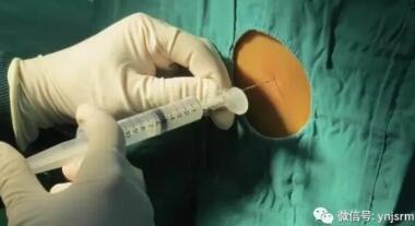  【健康】神经阻滞疗法在疼痛治疗中的奏效机制及治疗特点