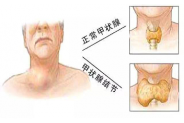  好消息！建水县人民医院甲状腺外科专科门诊正式开诊啦！